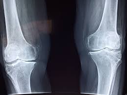 Related posts of muscle anatomy knee mri muscle anatomy get body smart. Knee X Ray