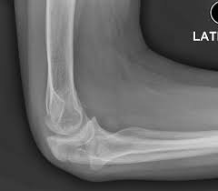 Image result for Radial Head Dislocation