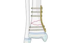 Open reduction; plate fixation for Multifragmentary complete ...