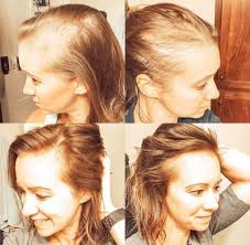 The hairline has specially thinned down towards the front, giving me a large forehead. What To Do For Thinning Hair How To Get Great Hair Every Day