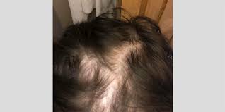 The cause of dandruff such as poor diet, stress, and certain ingredients in hair products and hair gel, is often the same cause for hair loss. Former Devacurl Aficionados Allege Products Cause Hair Loss