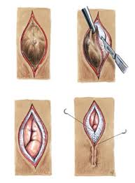 Ein nabelbruch soll ja unter umständen auch von allein heilen können, aber soweit ich weiß, rät man normalerweise zu einer operation, um inneren verletzungen. Uzh Nabelbruch Hernie