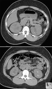 Nephrocalcinosis Medullary Sponge Kidney Calculi Stone Calculus Hyperparathyroid Medullary Sponge Kidney Pet Ct Renal Stones