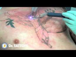 Tattoo Removal Before And After Video Angel Tattoo On Chest Removed Using Laser Tattoo Removal Youtube