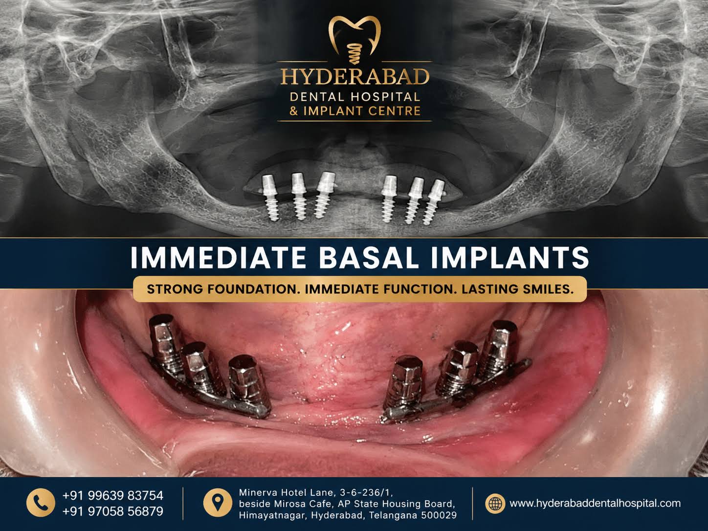 Immediate Basal Dental Implants