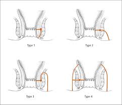 It usually follows an infection that didn't. Figure 031 4 7088 Types Of Fistula In Ano Type 1 Intersphincteric Fistula Type 2 Transsphincteric Fistula Type 3 Suprasphincteric Fistula Type 4 Extrasphincteric Fistula Illustration Courtesy Of Dr Shannon Zhang Mcmaster Textbook Of