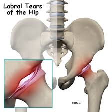 Image result for Hip Labral Tear