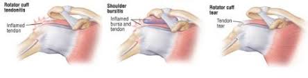 Image result for Rotator Cuff Injury