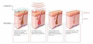 They involve using a beam of light over the skin which targets areas of high pigmentation, heating them to the point of destruction of the hair follicle. How Does Ipl Hair Removal Actually Work You Ask Laser Hair Reduction Laser Hair Removal Hair Removal