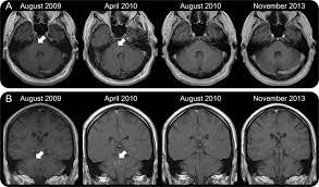 A case report and review of the literature. Clippers Induction And Maintenance Of Remission Using Hydroxychloroquine Neurology Neuroimmunology Neuroinflammation