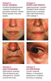 Despite intensive topical therapy, treatment with oral corticosteroids and oral doxycycline was unable to achieve suff …. Pinterest