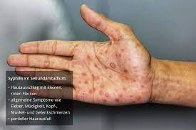 Hautausschläge selbst sind symptome von erkrankungen. Wie Aussert Sich Eine Syphilis Auf Der Haut