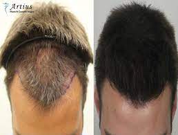 Hasson have been practicing hair transplant surgery for more than 20 years each. When Does Hair Starts To Grow After A Hair Transplant Artius Hair Transplant