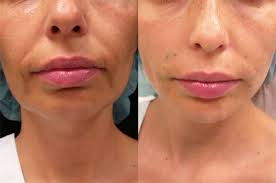 How To Look Young For Decades Without Getting A Facelift Plastic Surgery Laser Skin Look Younger