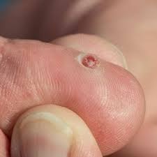 Image result for Pyogenic Granuloma