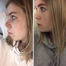 My official before and after photos at the 6 week mark! (lower jaw  advancement and genioplasty)