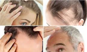 This may be permanent or temporary (depending on the underlying causes), and its impact differs from one man to other. Pin On How To Grow New Hair