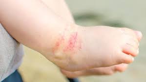 Eksim (dermatitis atopik) jika anda atau anak anda memiliki bercak merah dan bersisik yang sangat gatal, bisa jadi itu adalah eksim. Kulit Anda Gatal Dan Merah Bisa Jadi Anda Terkena Dermatitis Atopik Wecare Id