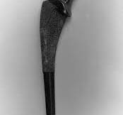 Plasma spray-coated Ti femoral component for cementless ...