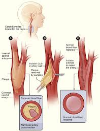 There are two internal carotid arteries in total, one on each side of the neck. Carotid Artery Disease Clinical Features Management Teachmesurgery