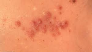 Image result for Cimex lectularius bites