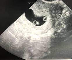 We're sure you've got a lot to cope with, so if you we went for an ultrasound at 6 weeks 4 days, and there were 3 gestational sacs. 7 Weeks Pregnant With Twins Twiniversity