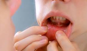 Image result for dental cancer