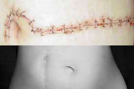 Laparoscopic and robotic gastric sleeve surgery is less invasive than open weight loss surgery. Scarring And Weight Loss Surgery Lifetime Surgical