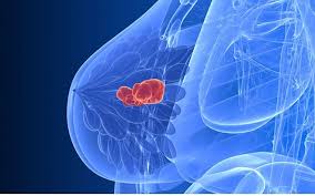 New data on the galleri blood test (from grail) show that it detected a cancer signal for a broad range of cancer types and that more than half of the cancers that were detected were of early. Breast Cancer Blood Test Could Detecting Relapse Earlier