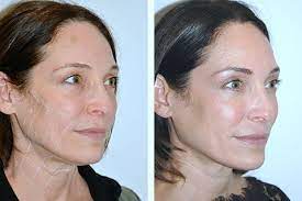 Non Surgical Facelift Non Surgical Face Lift Nyc