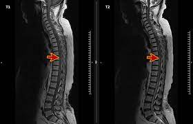 Cureus Acute Spinal Extradural Hematoma And Cord Compression Case Report And A Literature Review