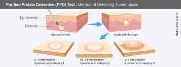 A few people infected with the bacteria that cause tb may not have a reaction. Tuberculosis Skin Test Ppd Reading Results Side Effects Risks