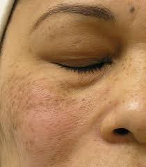Um dem wunsch der nachhaltigkeit nachzukommen, richtete man eine pelletheizung mit unterirdischem. Hydra Facial Medical Wellness Deege De