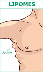 Lipomes Comment Guerir Les Petites Boules Sous La Peau Naturellement Health Tips For Women Health Tips Emergency Medical