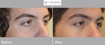 Cat eye lift, or canthoplasty, is considered a fairly minimally invasive procedure without a lengthy recovery period. Before And After Canthoplasty Photos Mehryar Ray Taban Md