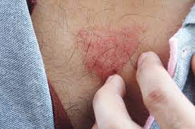Ilustrasi kulit gatal (istockphoto) liputan6.com, jakarta memiliki ruam merah pada kulit sudah pasti sangat mengganggu. Awas Pityriasis Rosea Sebabkan Ruam Sebesar Koin Dan Bersisik