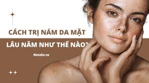 Mách Bạn Các Cách Trị Nám Da Mặt Lâu Năm Hiệu Quả Nhất Hiện Nay Natalie.vn
