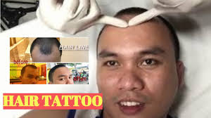 SCALP MICROPIGMENTATION