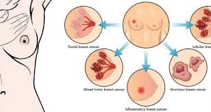 Anyone can develop inflammatory breast cancer, including men. Breast Cancer Organisation India Turns Pink Breast Caner Awareness Breast Cancer Organisation Breast Cancer Awareness Foundation Breast Cancer Ngo Breast Cancer Awareness In India Breast Cancer Awareness In Chennai