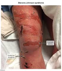 Image result for Erythema Multiforme Major