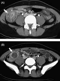 The mold that triggers the illnesses, aspergillus, is everywhere — indoors and outdoors. Abdominal Aspergillosis Ct Findings European Journal Of Radiology
