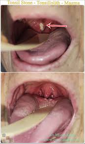 Image result for Tonsillolith