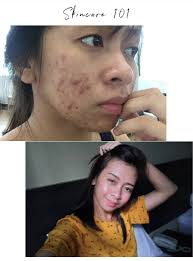 Saya pasti sangat saper2 yang terjah blog nih kali ni adalah someone yang punya masalah jerawat… betul tak. 5 Produk Hilangkan Jerawat Berkesan Yang Penting Bahan Ni Kena Ada