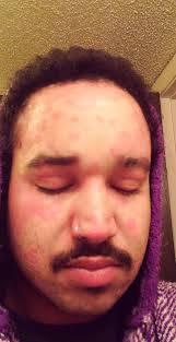 I have scalp psoriasis and wanted to share this with you.I have had it for  years and nothing has helped until my Dr sent me to an ENT for hearing loss  and