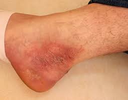 Image result for Neurodermatitis