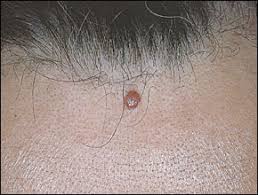 They are less common on the scalp. Electrosurgery For The Skin American Family Physician
