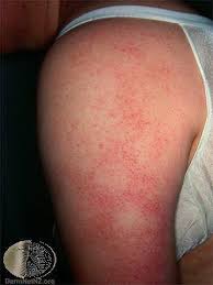 They might be the same color as the skin or slightly red. Keratosis Pilaris Treatment Colorado Springs Monument Co