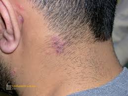 Image result for herpes zoster