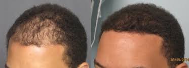 How much hair you want transplanted: Fue Hair Transplant Los Angeles Dr Sean Behnam