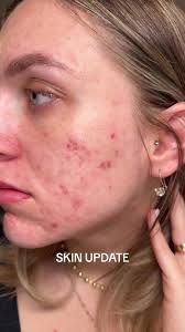 Skin Update: Progress